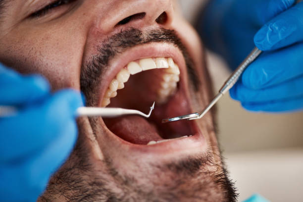 Best Emergency Wisdom Teeth Removal in Matawan, NJ